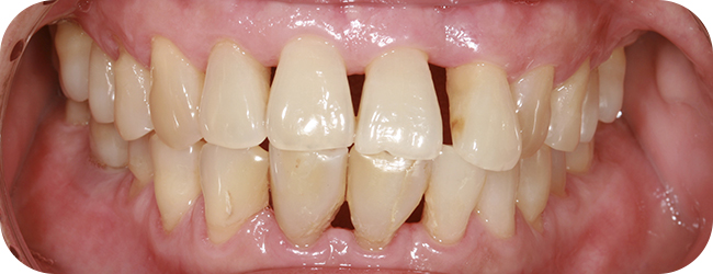 Clinique-dentaire-du-versant-parodontite-WEB